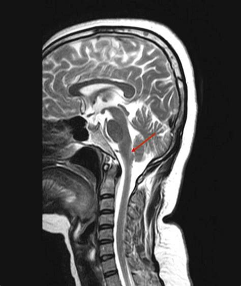 Cureus Intractable Vomiting And Hiccups An Atypical Presentation Of