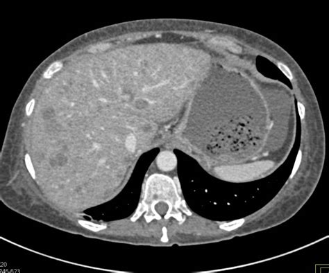 Liver Abscess Liver Case Studies Ctisus Ct Scanning