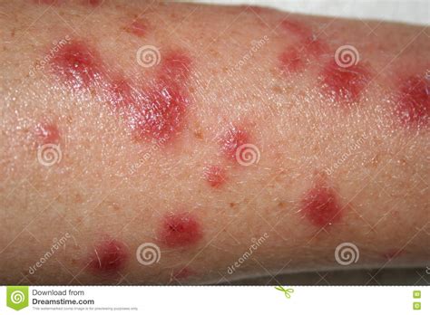 Ugly Skin Rash Stock Image Image Of Infection Ointment