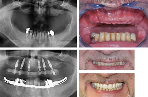 Implantologia A Carico Immediato Studio Dentistico Del Corso