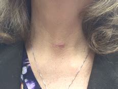 Scar After Parathyroid Surgery Parathyroid Surgery Org