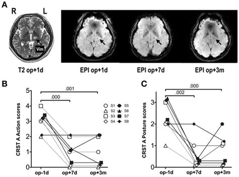 frontiers hierarchical dynamic causal modeling of resting state fmri reveals longitudinal