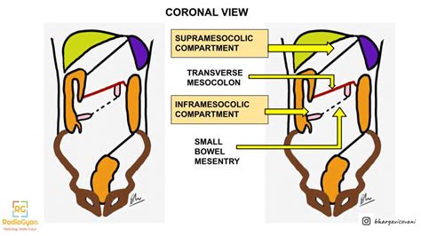 The Potential Spaces Mapping The Peritoneal Cavity Com Radiogyan