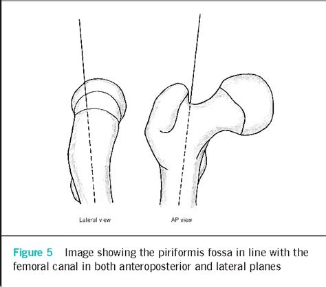 Figure 4 From Piriformis Fossa Approach In Optimising Femoral Neck