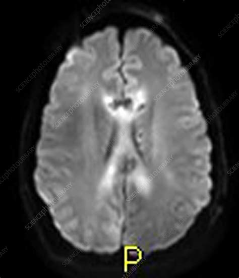 Severe Traumatic Brain Injury Mri Stock Image C0271727 Science