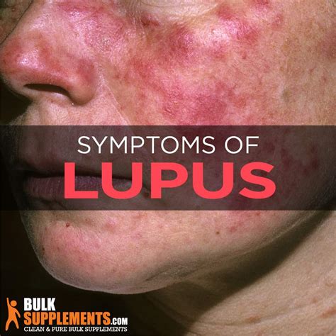 Lupus Diagnosis Later In Life