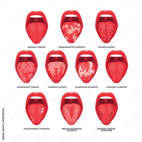 Set Of Different Types Of Glossitis Collection Diagram Of Tongue