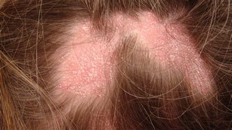 Red Spots On Scalp Pictures Causes And Treatments Vlr Eng Br