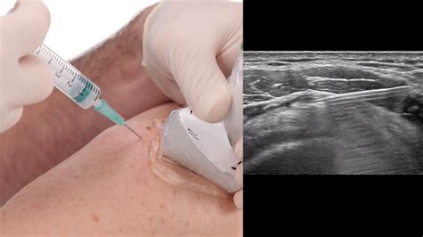 Ultrasound Guided Joint Injection Course Gsa
