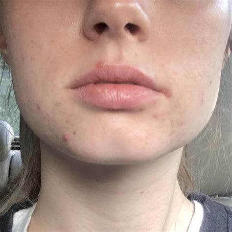 Skin Concern First Time Poster Zits On Lip Line Post In Comments