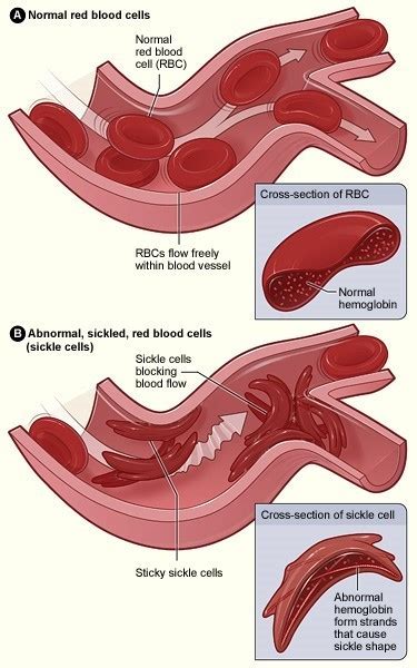 Sickle Cell Disease Causes And Risk Factors Nhlbi Nih