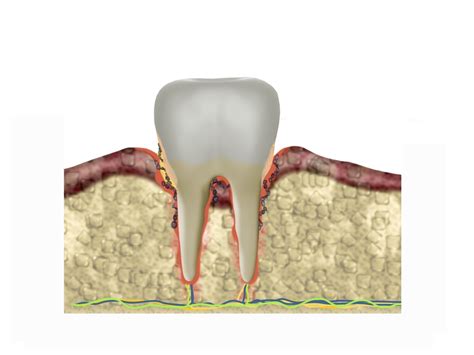 What Are Periodontal Pockets Pickett Family Dental