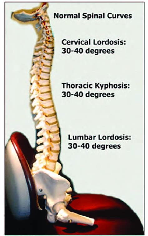 Understanding Spinal Curvatures Kyphosis Lordosis And Scoliosis