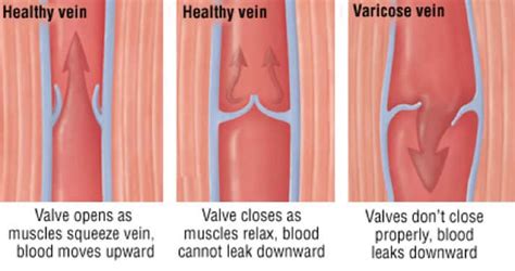Varicose Veins Leg Swelling Cardiovascular Health Clinic