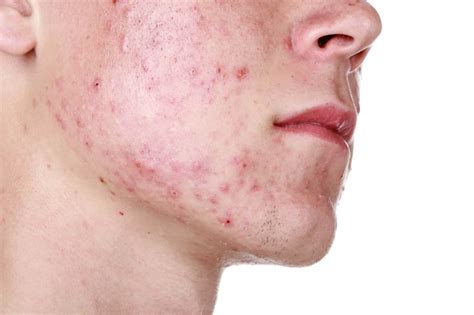 guy with alot of pimples