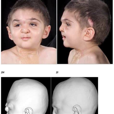 A C Frontal Lateral And Vertical Views Of A Patient With Apert