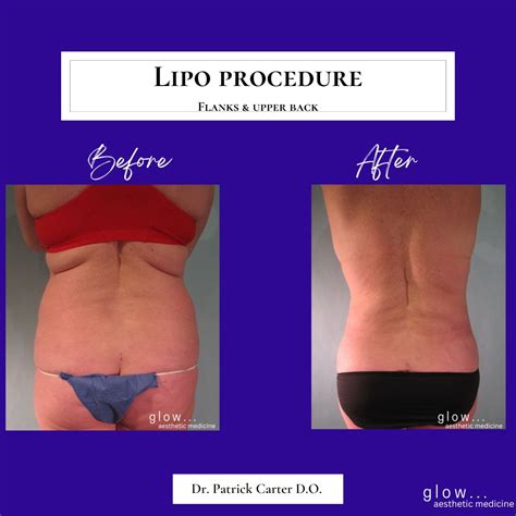 Flank Liposuction Before And After Glow Aesthetic Medicine