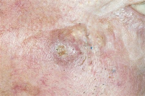 Basal Cell Carcinoma Skin Cancer Stock Image C0085695 Science