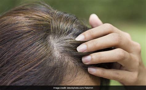 Unlike commonly thought of, only severe or chronic loss of proteins, iron, folic acid, vitamin b12 and copper can cause premature greying of hair. Premature Greying Of Hair: Know The Causes And Tips For ...