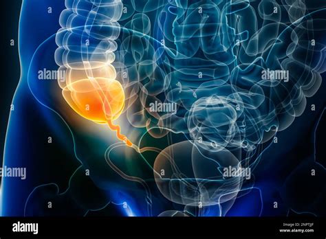 Enfermedad De Apendicitis O Inflamación Vermiforme Del Apéndice 3d Que