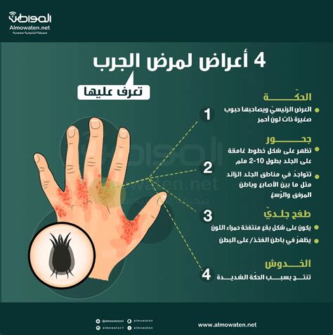 وارجو مشاهدة كامل سلسلة الجرب ليتسنى لكم الحصول على العلاج والنجاح في تطبيقه. 4 أعراض لمرض الجرب.. تعرَّف عليها | صحيفة المواطن الإلكترونية