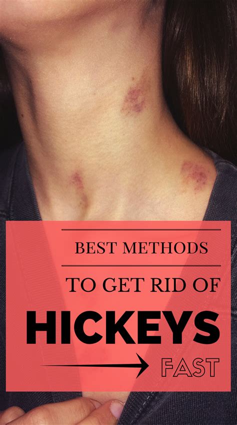 here are best methods to get rid of hickeys fast hickeys get rid of hickies hickies