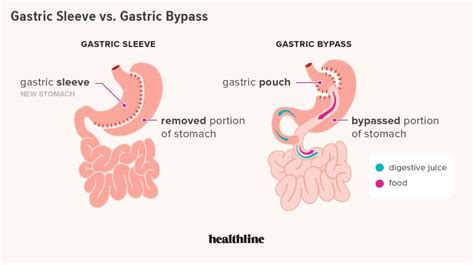 Gastric Sleeve Vs Gastric Bypass Differences Pros Cons Gastric