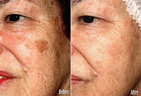 Check spelling or type a new query. Age Spots Treatment Options - Castleknock Cosmetic Clinic