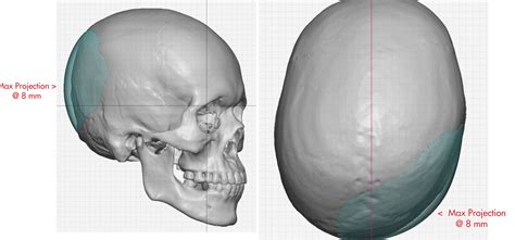 Right Occipital Skull Plagiocephaly Implant Dimensions Ddr Barry Eppley