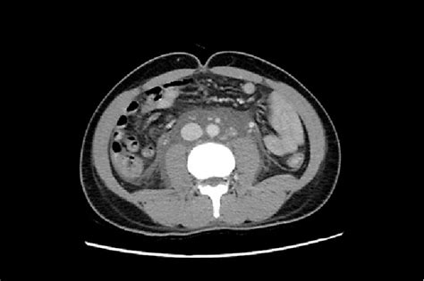 Figure 2 From Primary Retroperitoneal Filariasis Presenting With Acute