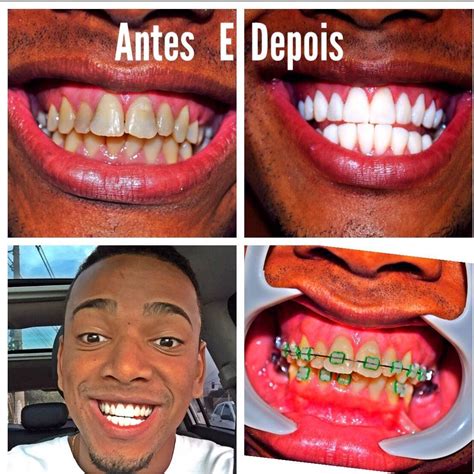 Nego do borel, artistic name of leno maycon viana gomes (born 10 july 1992), is a brazilian singer of funk ostentação, songwriter and actor. Nego do Borel compra sorriso novo por R$ 150 mil - Fotos ...