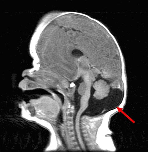 T1 Weighted Sagittal Mri Of The Patient Note The Deformation Of The