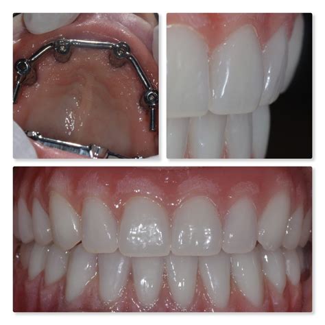 Dental Implant Retained Denture Leeds Securing Your Teeth