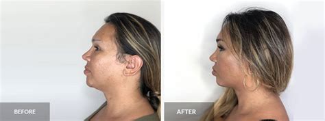 facial feminization surgery before and after south florida center for cosmetic surgery