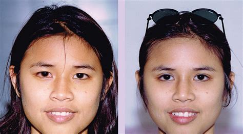 dr chettawut sex reassignment and facial feminization surgery center upper eyelid double