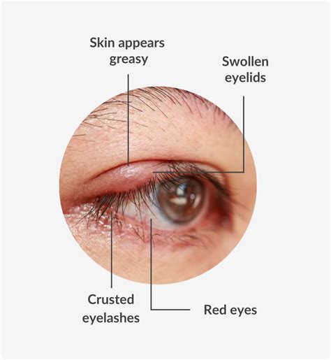 Blepharitis Symptoms Causes And Possible Treatments Vision Direct Au