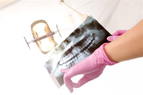 Please contact your physician's office for physician fees and your health insurance provider directly for. Dental X-rays: 7 of Your Top Questions, Answered! | Gentle ...