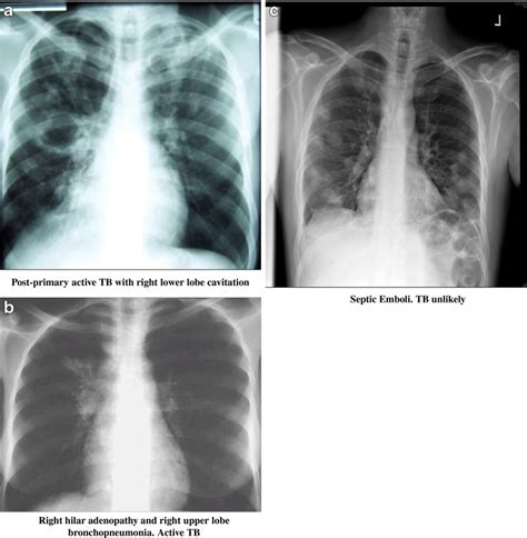Three Examples Of Chest X Rays From The Tuberculosis Cxr Image