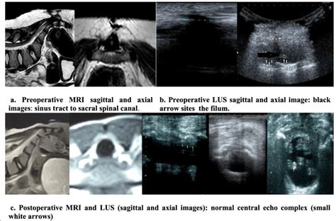 Skin Dimple At The Lower Back A Preoperative Mri Sagittal And Axial