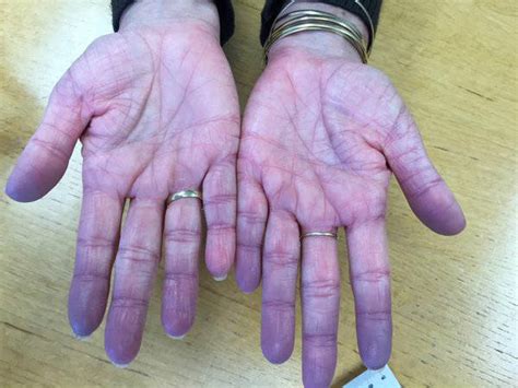 What Is Cyanosis First Aid For Free