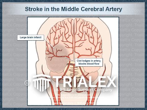 Stroke In The Middle Cerebral Artery Trialexhibits Inc