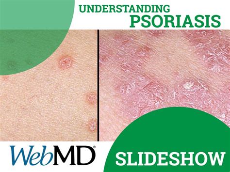 When Psoriasis Starts You May See A Few Red Bumps On Your Skin These