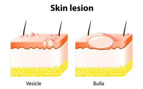 Skin Lesions Symptoms Causes And Treatment Skinkraft