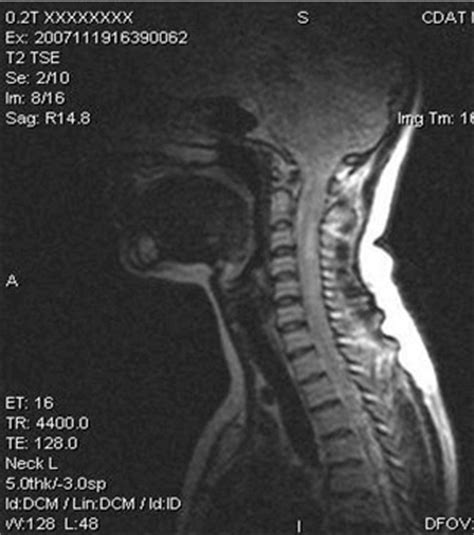 Cual es la prueba mas sensible en la esclerosis multiple. Presentacion de un caso clinico. Esclerosis Multiple por ...