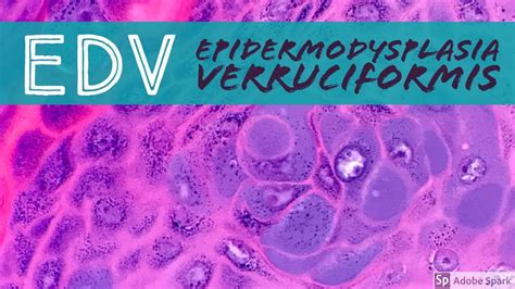 Epidermodysplasia Verruciformis Edv Youtube
