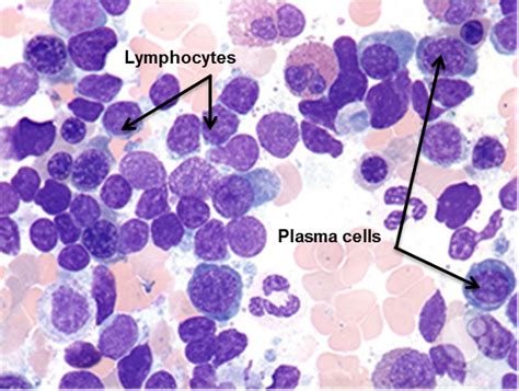 Lymphoma Action Lymphoplasmacytic Lymphoma And Waldenströms