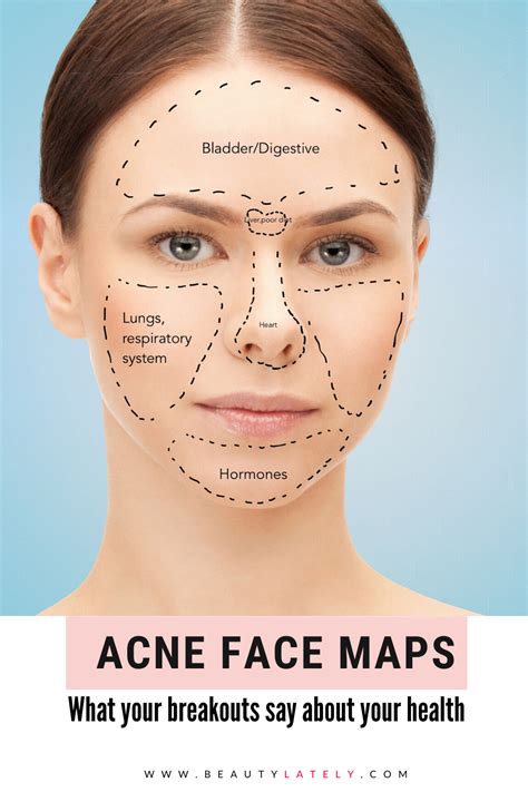 Acne Face Maps The Reasons Behind Your Breakouts Face Mapping Acne