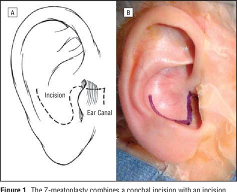 The Z Meatoplasty For Modified Radical Mastoidectomy In Children