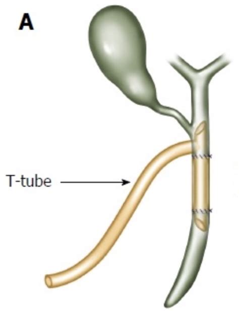 Common Bile Duct Exploration The Operative Review Of Surgery
