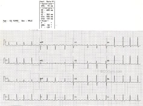 Atrial Flutter With Variable Conduction Ecg Guru Instructor Resources